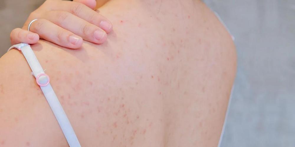 Symptoms of body acne